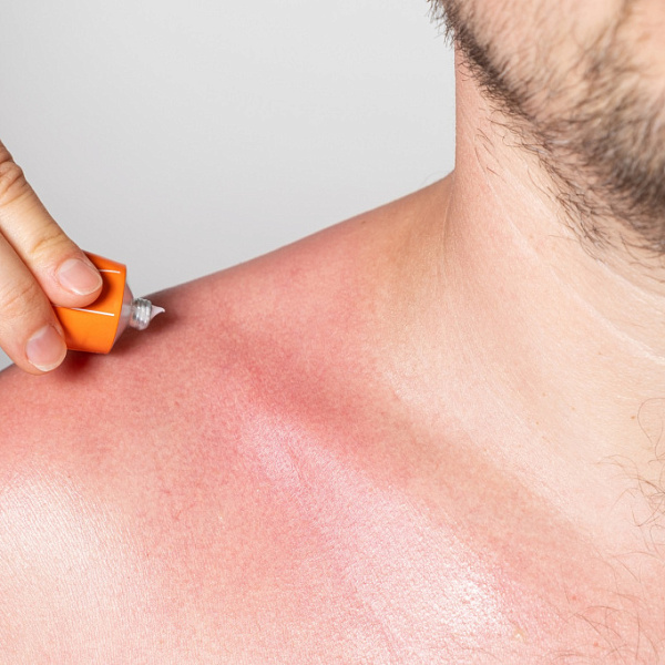 Что такое солнечная крапивница и как её избежать